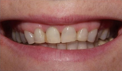 Close up of smile with yellow stains on some teeth