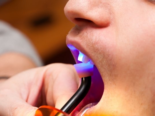 Close up of dental patient getting cosmetic bonding on a tooth