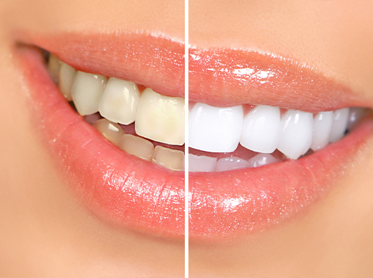 Close up of smile before and after teeth whitening