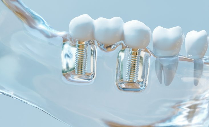 Model of the jaw with two dental implants in Longmeadow