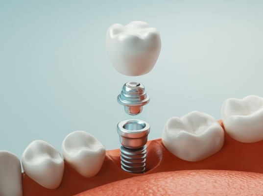 Illustrated dental implant with dental crown and abutment