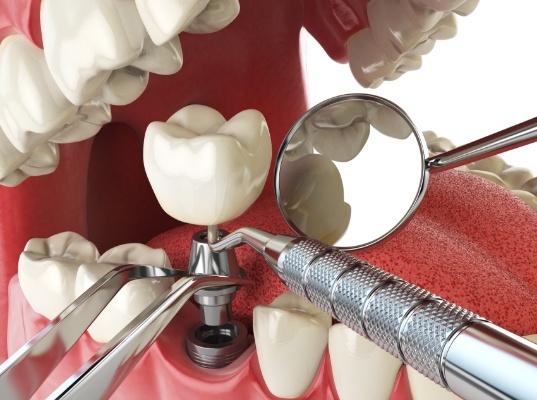 Illustrated dental implant being placed in the lower jaw