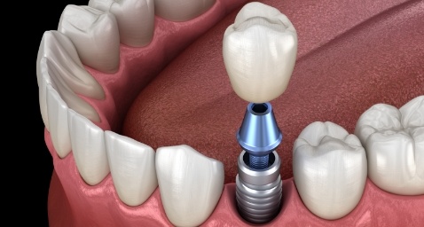 Illustrated dental crown being placed onto a dental implant