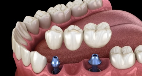 Illustrated dental bridge being placed onto two dental implants