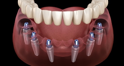 Illustrated full denture being placed onto six dental implants