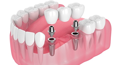 Illustration of an implant bridge