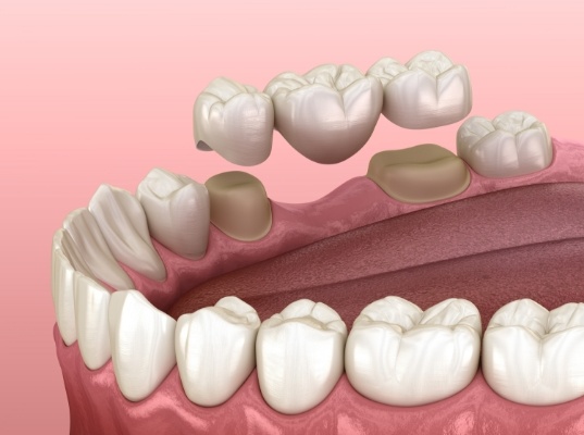 Illustrated dental bridge replacing a missing tooth