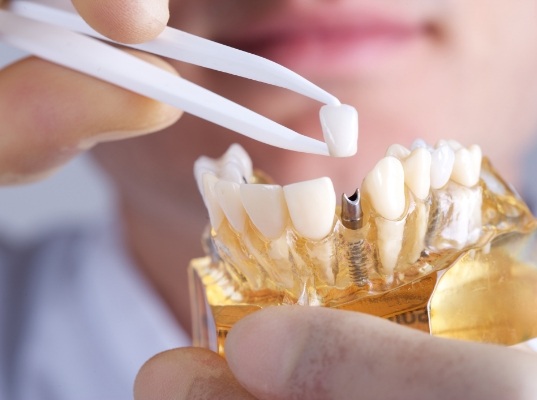 Dentist placing a crown onto a model of a dental implant