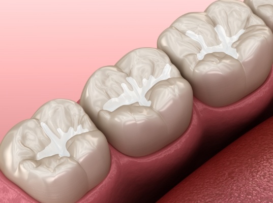 Illustrated row of teeth with tooth colored fillings