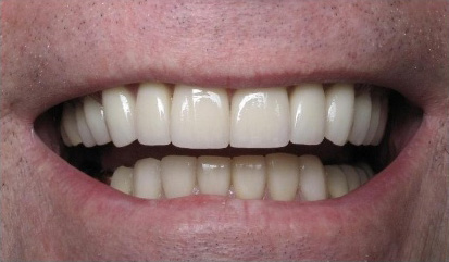 Close up of smile with brighter teeth