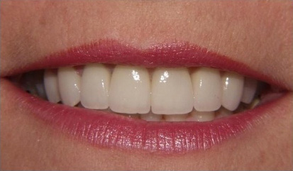 Close up of smile with whiter teeth