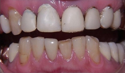 Close up of slightly discolored teeth